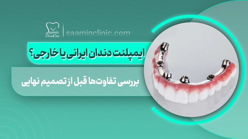 تصویری از کاور مقاله ایمپلنت دندان ایرانی با خارجی