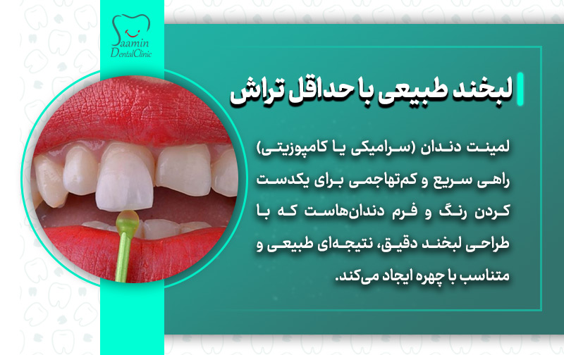 تصویری از نصب لمینت و توضیح لبخند طبیعی با حداقل تراش لمینت