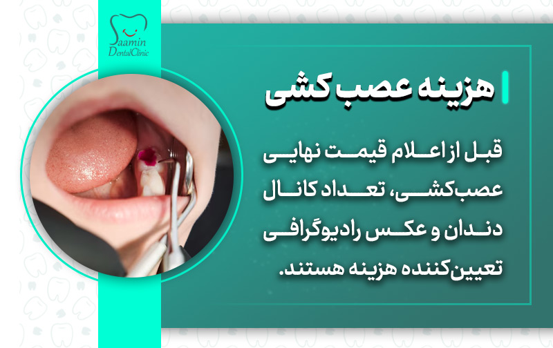 تصویری از دندان های بیمار در حال عصب کشی و توضیح هزینه و قیمت عصب کشی دندان