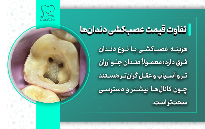 تصویری از یک دندان عصب کشی شده و توضیح تفاوت قیمت عصب کشی دندان ها