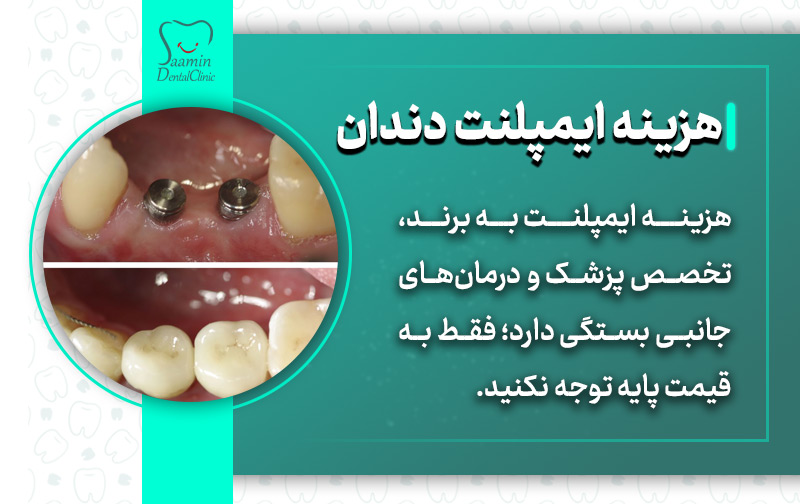 تصویری از نصب ایمپلنت دندان و توضیح هزینه ایمپلنت دندان