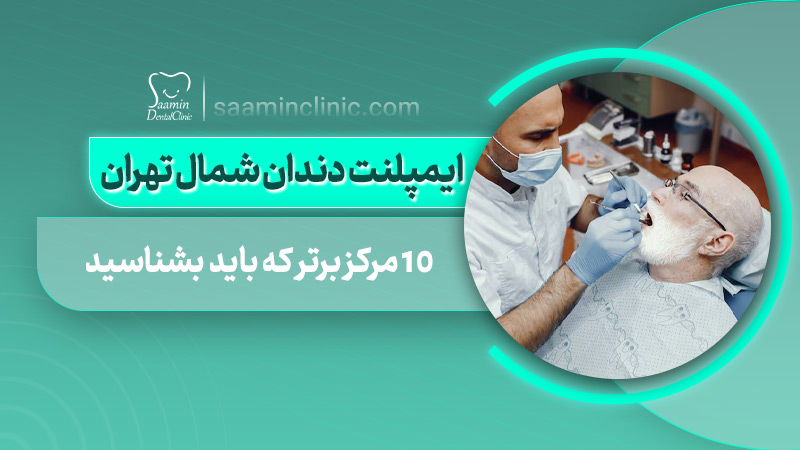 تصویری از کاور مقاله ۱۰ مرکز برتر ایمپلنت دندان در شمال تهران